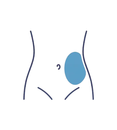 Sarcomas Retroperitoneais